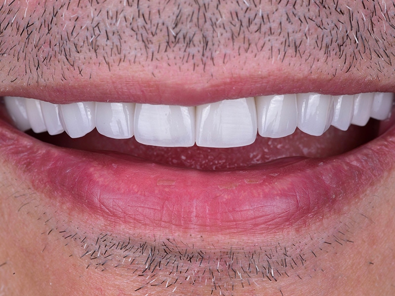 Smile Makeover Closeups Before & After Gallery - Patient 265762 - Image 2