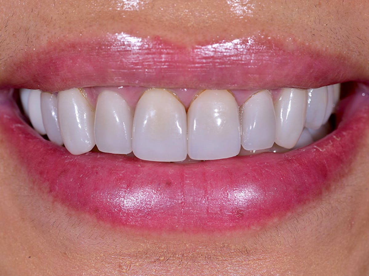 Smile Makeover Closeups Before & After Gallery - Patient 148992 - Image 1
