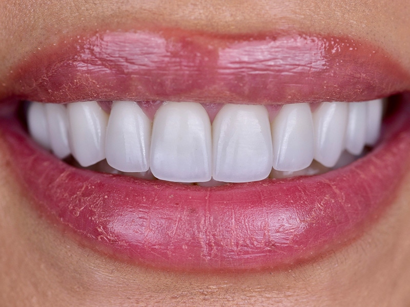 Smile Makeover Closeups Before & After Gallery - Patient 148992 - Image 2