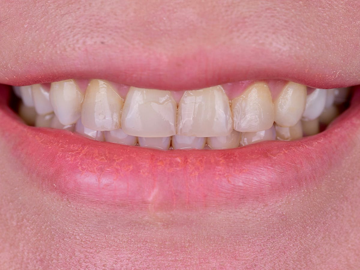 Smile Makeover Closeups Before & After Gallery - Patient 248724 - Image 1