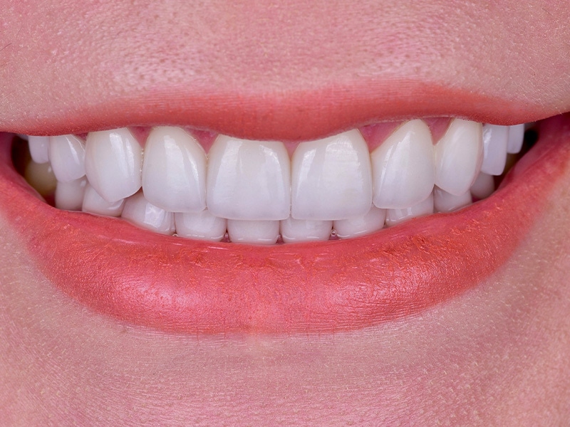 Smile Makeover Closeups Before & After Gallery - Patient 248724 - Image 2