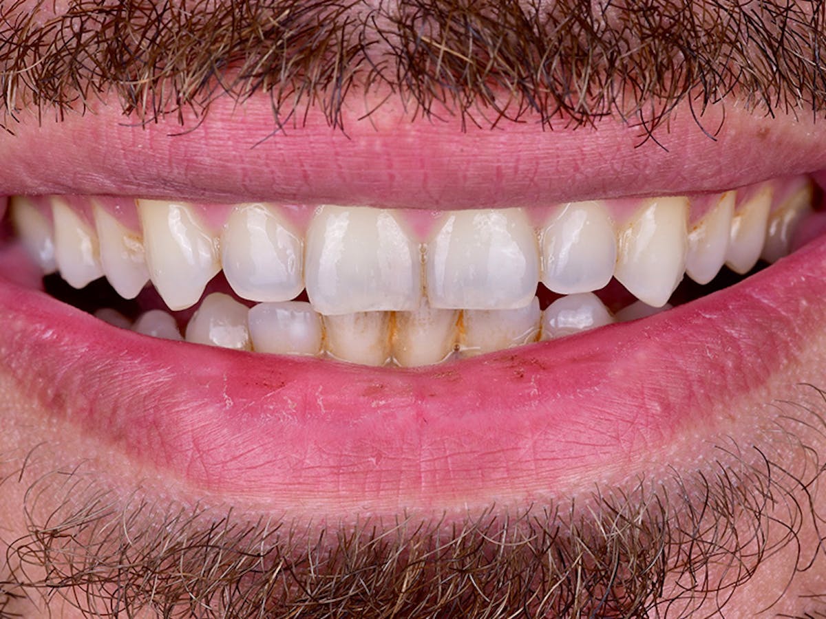 Smile Makeover Closeups Before & After Gallery - Patient 973947 - Image 1