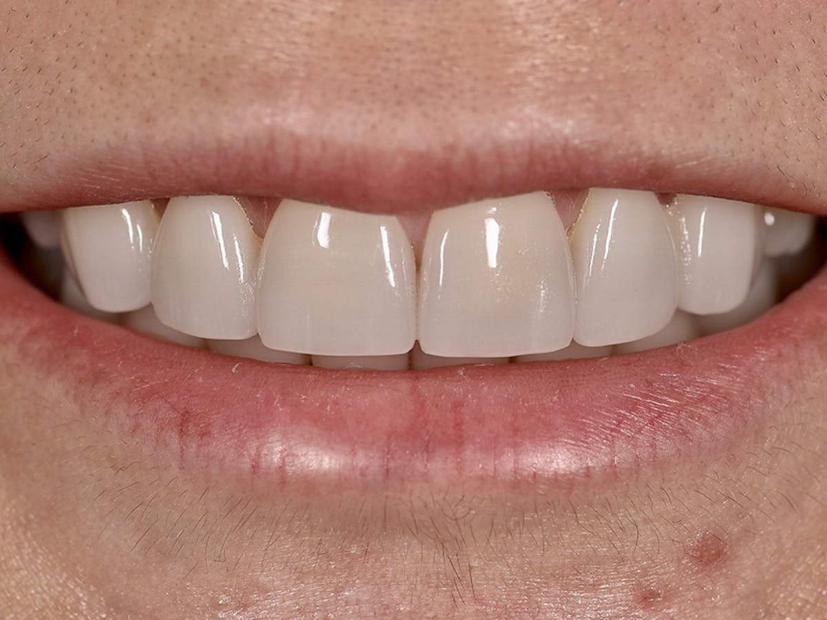 Smile Makeover Closeups Before & After Gallery - Patient 353445 - Image 1