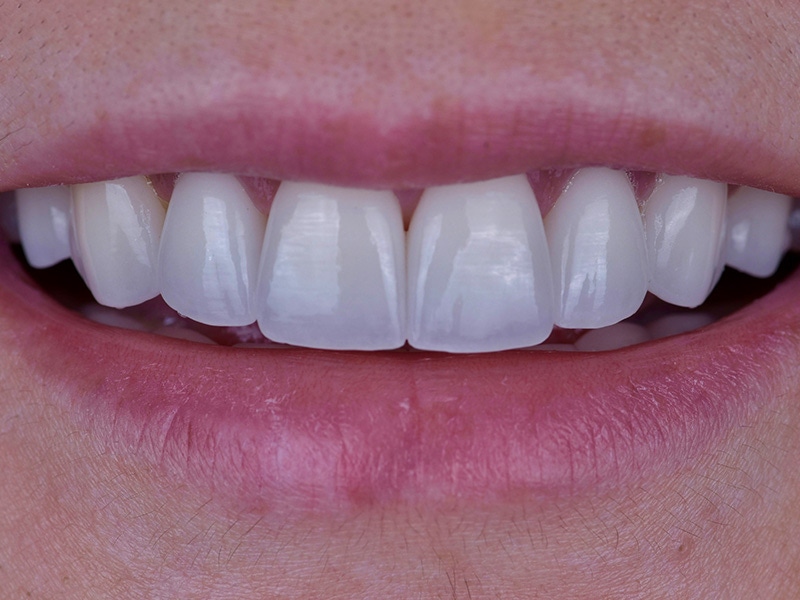 Smile Makeover Closeups Before & After Gallery - Patient 353445 - Image 2