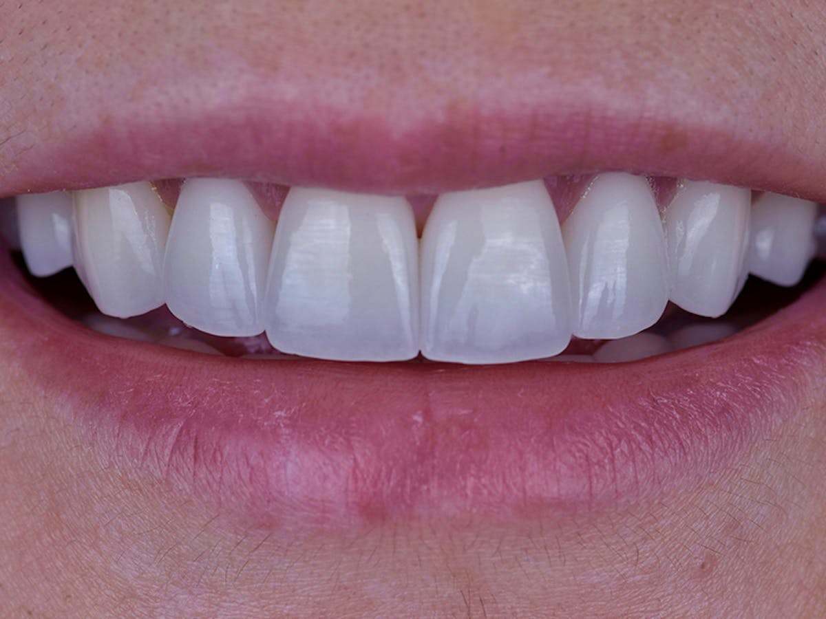 Smile Makeover Closeups Before & After Gallery - Patient 353445 - Image 2