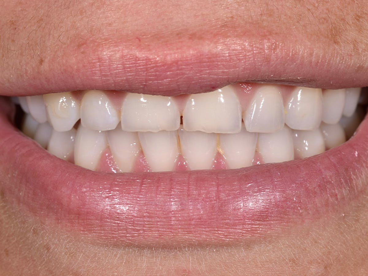 Smile Makeover Closeups Before & After Gallery - Patient 100593 - Image 1