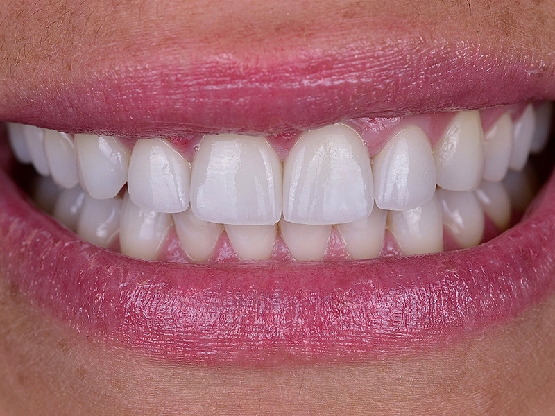 Smile Makeover Closeups Before & After Gallery - Patient 100593 - Image 2