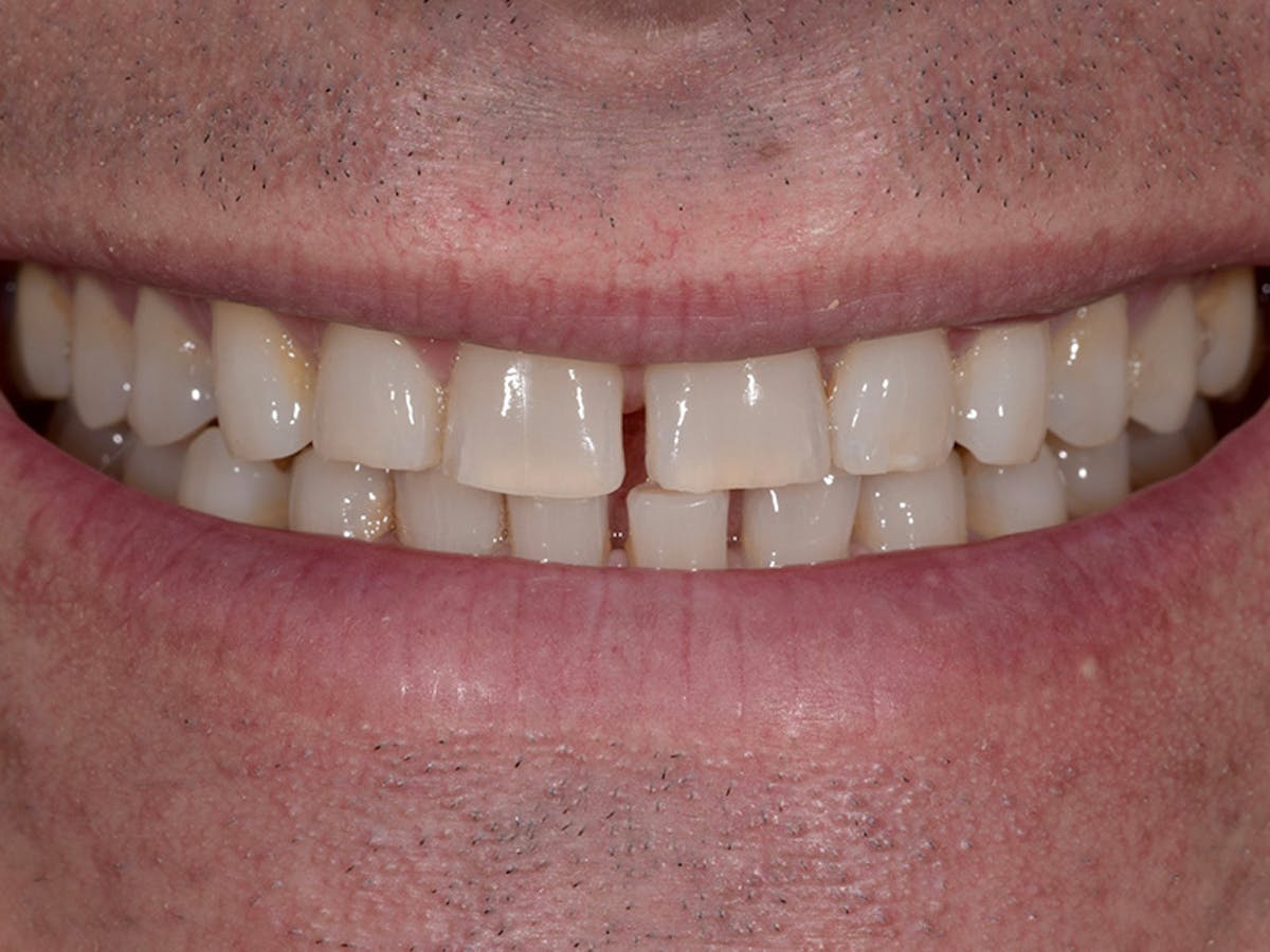 Smile Makeover Closeups Before & After Gallery - Patient 336517 - Image 1