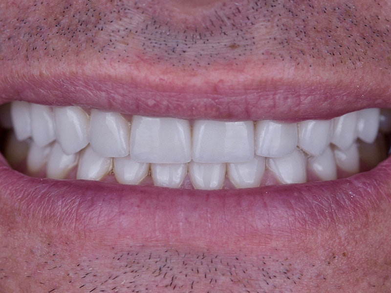 Smile Makeover Closeups Before & After Gallery - Patient 336517 - Image 2
