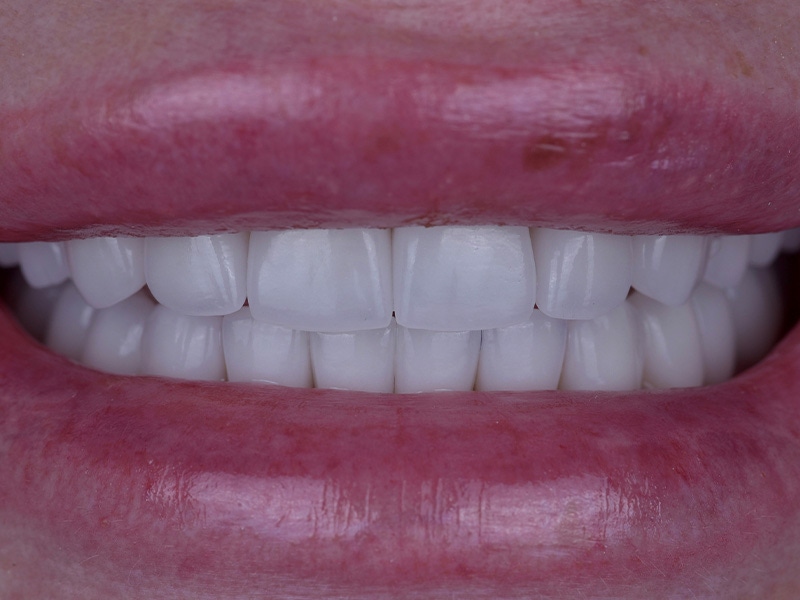 Smile Makeover Closeups Before & After Gallery - Patient 216343 - Image 2