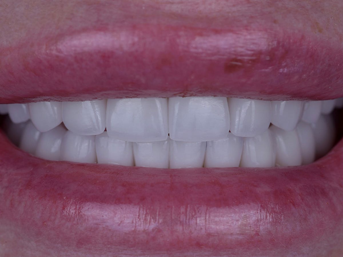 Smile Makeover Closeups Before & After Gallery - Patient 216343 - Image 2