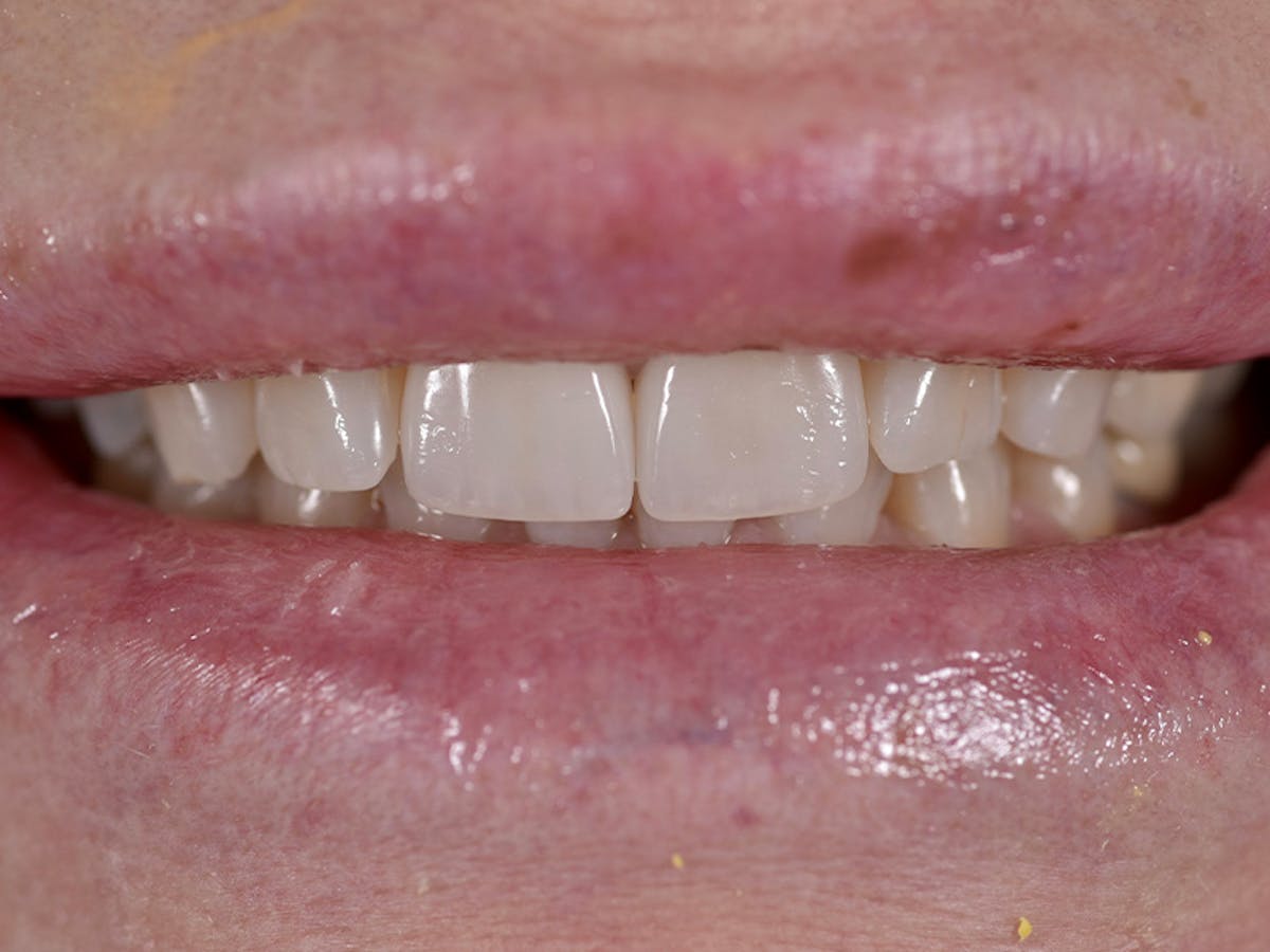 Smile Makeover Closeups Before & After Gallery - Patient 216343 - Image 1