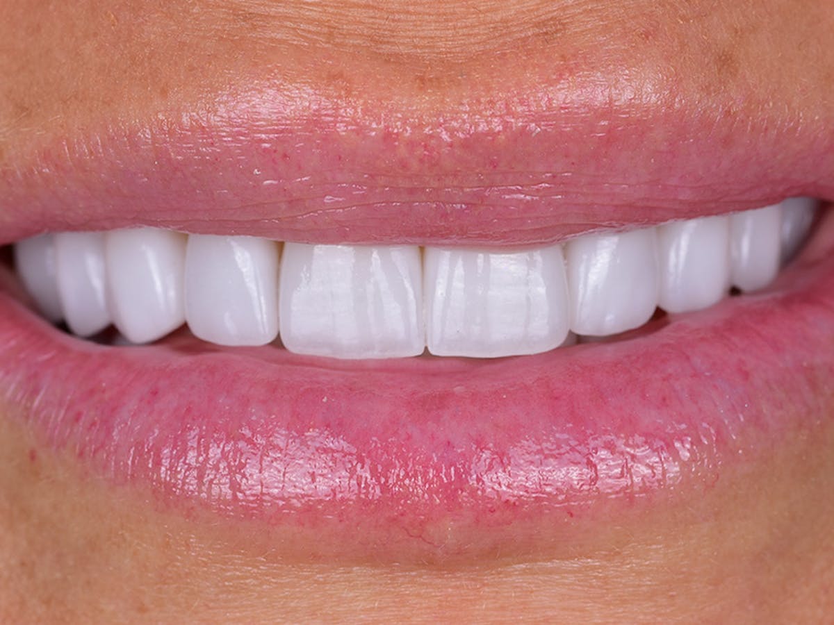 Smile Makeover Closeups Before & After Gallery - Patient 426330 - Image 2