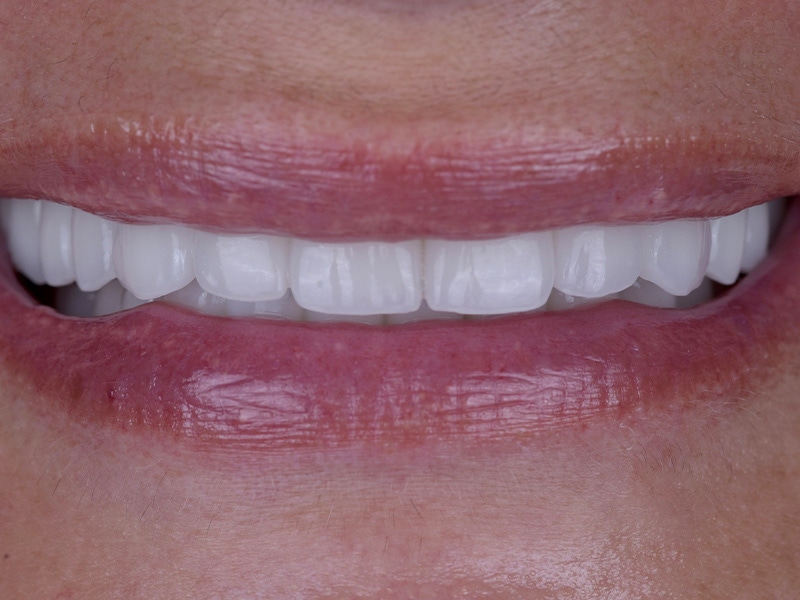Smile Makeover Closeups Before & After Gallery - Patient 426330 - Image 1