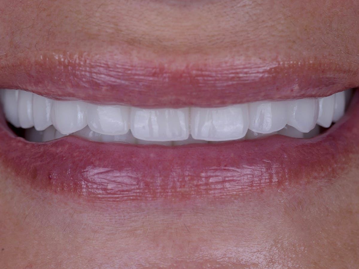 Smile Makeover Closeups Before & After Gallery - Patient 426330 - Image 1