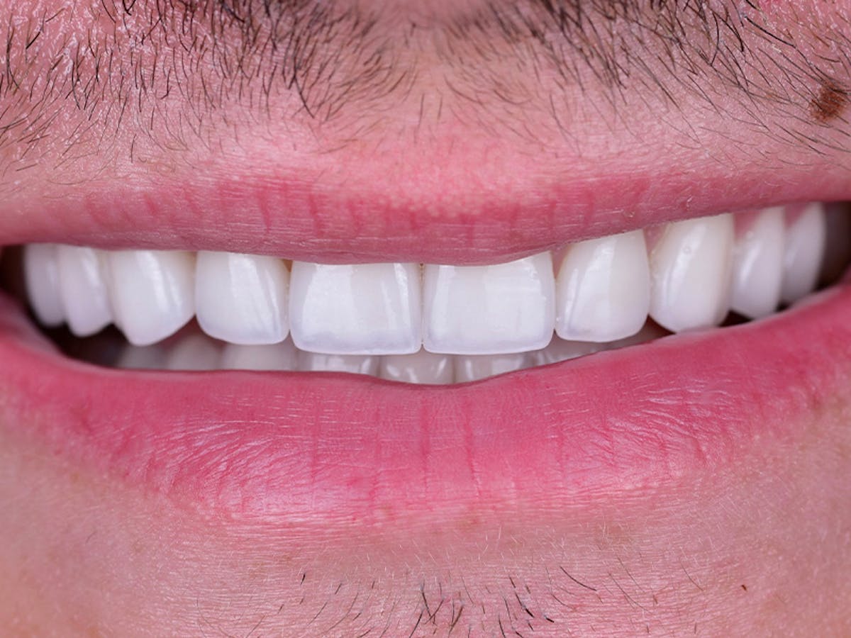 Smile Makeover Closeups Before & After Gallery - Patient 321702 - Image 2