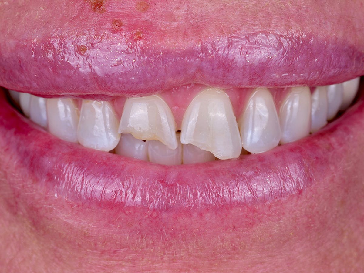 Smile Makeover Closeups Before & After Gallery - Patient 378550 - Image 1