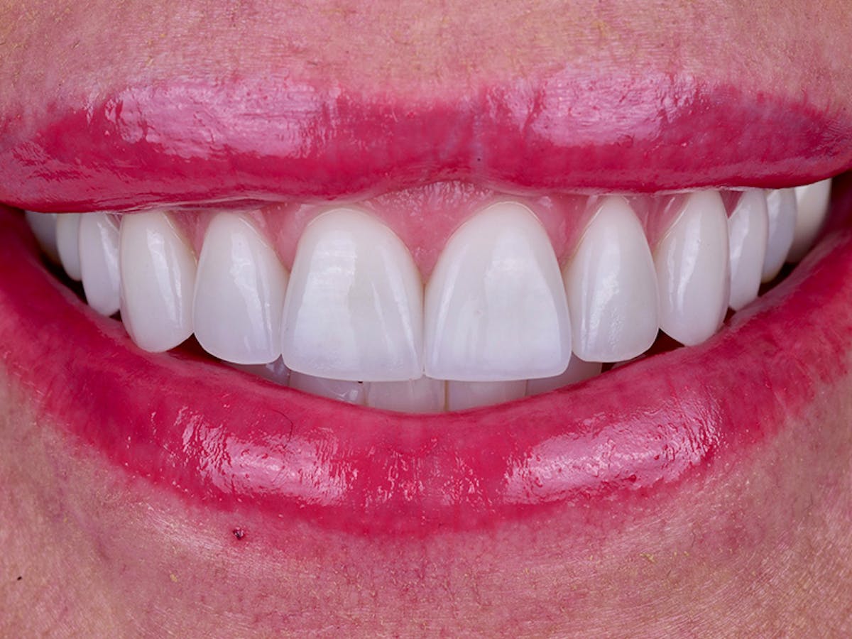 Smile Makeover Closeups Before & After Gallery - Patient 378550 - Image 2