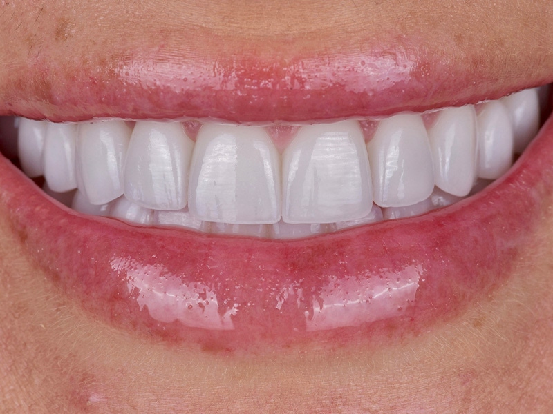 Smile Makeover Closeups Before & After Gallery - Patient 412839 - Image 2