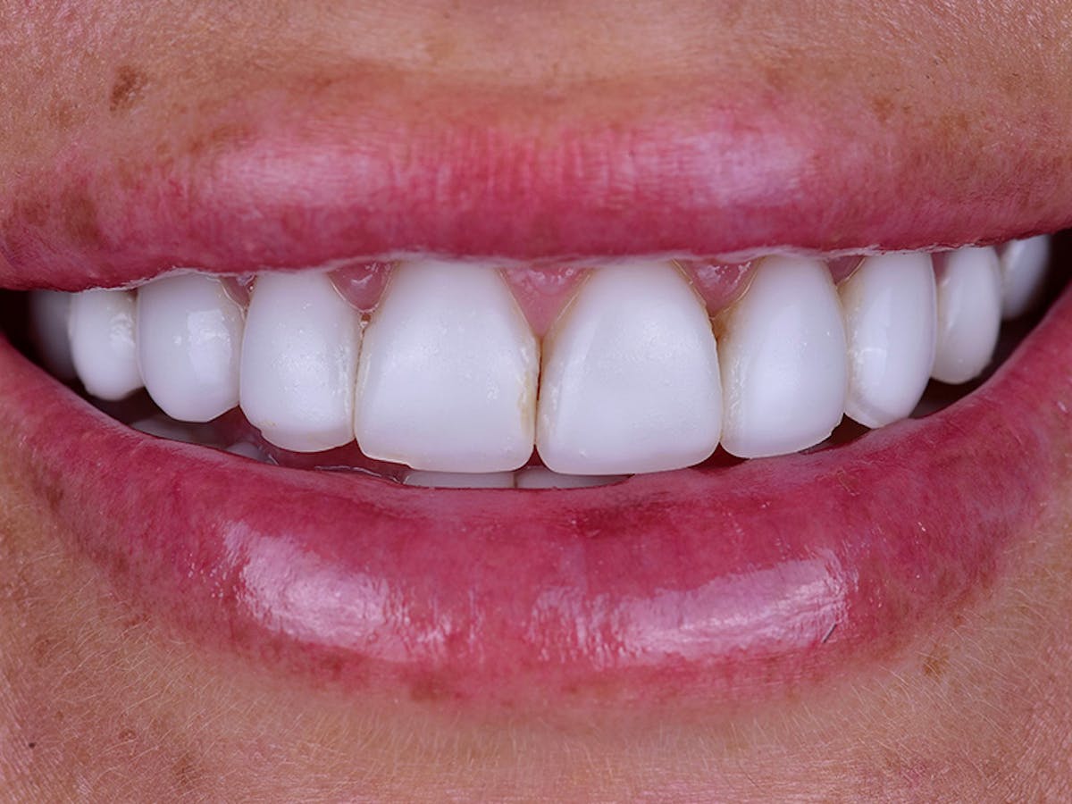 Smile Makeover Closeups Before & After Gallery - Patient 412839 - Image 1