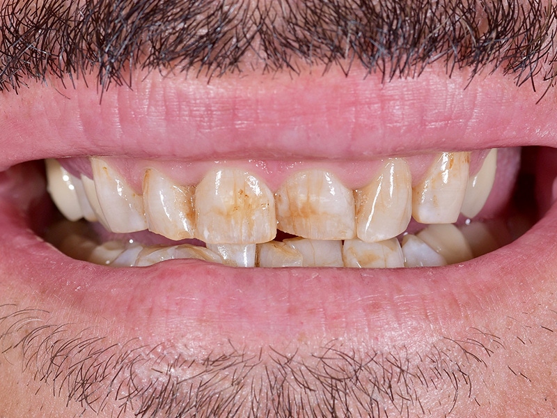 Smile Makeover Closeups Before & After Gallery - Patient 316958 - Image 1