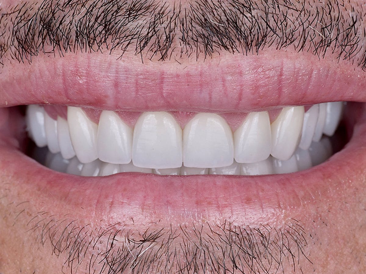 Smile Makeover Closeups Before & After Gallery - Patient 316958 - Image 2