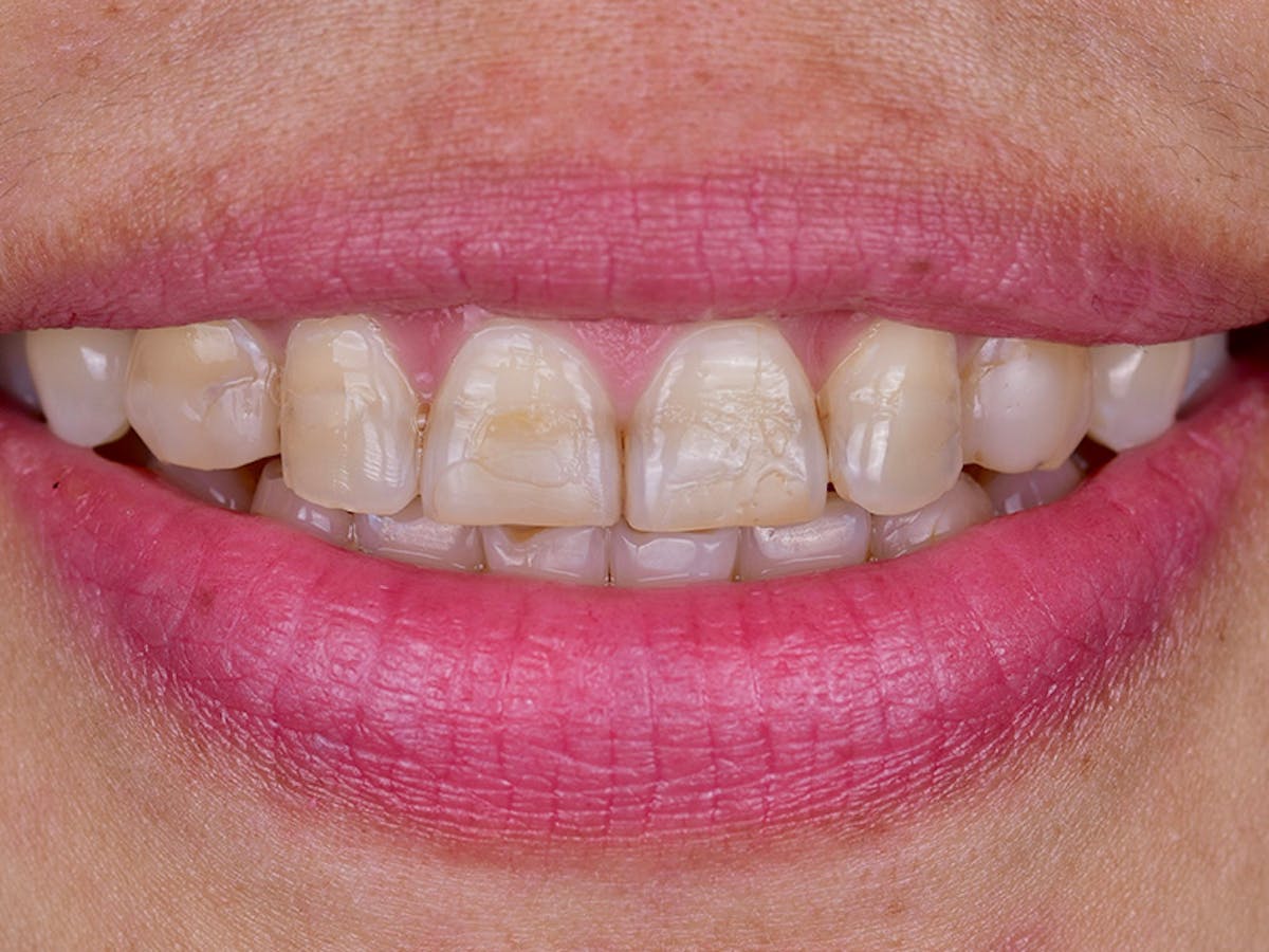 Smile Makeover Closeups Before & After Gallery - Patient 339370 - Image 1