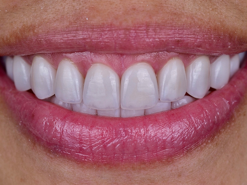 Smile Makeover Closeups Before & After Gallery - Patient 339370 - Image 2