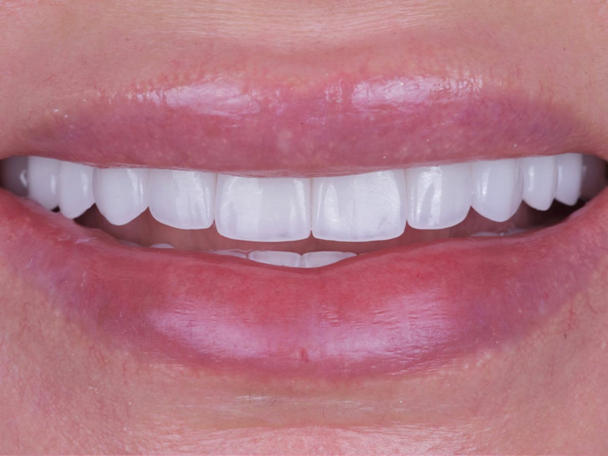 Smile Makeover Closeups Before & After Gallery - Patient 303810 - Image 2