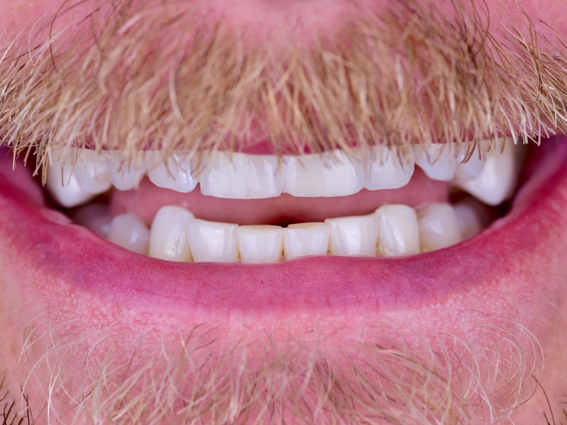 Smile Makeover Closeups Before & After Gallery - Patient 366362 - Image 1