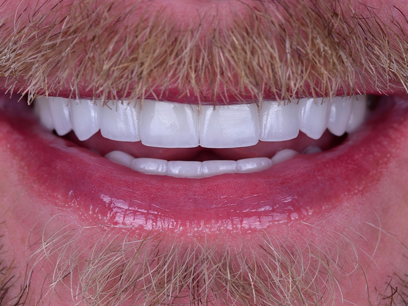 Smile Makeover Closeups Before & After Gallery - Patient 366362 - Image 2
