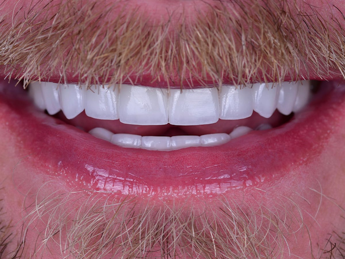 Smile Makeover Closeups Before & After Gallery - Patient 366362 - Image 2