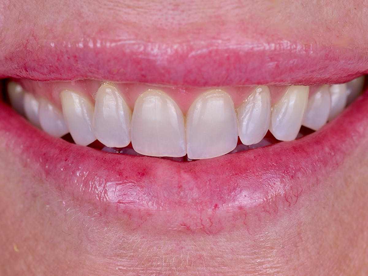 Smile Makeover Closeups Before & After Gallery - Patient 111201 - Image 1