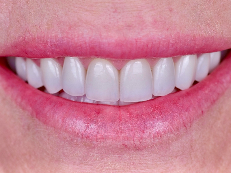 Smile Makeover Closeups Before & After Gallery - Patient 111201 - Image 2