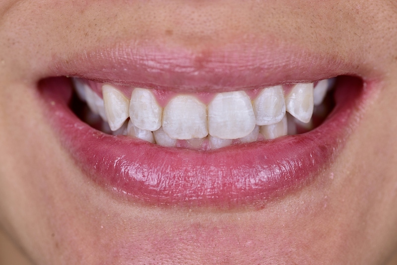 Smile Makeover Closeups Before & After Gallery - Patient 172040 - Image 1