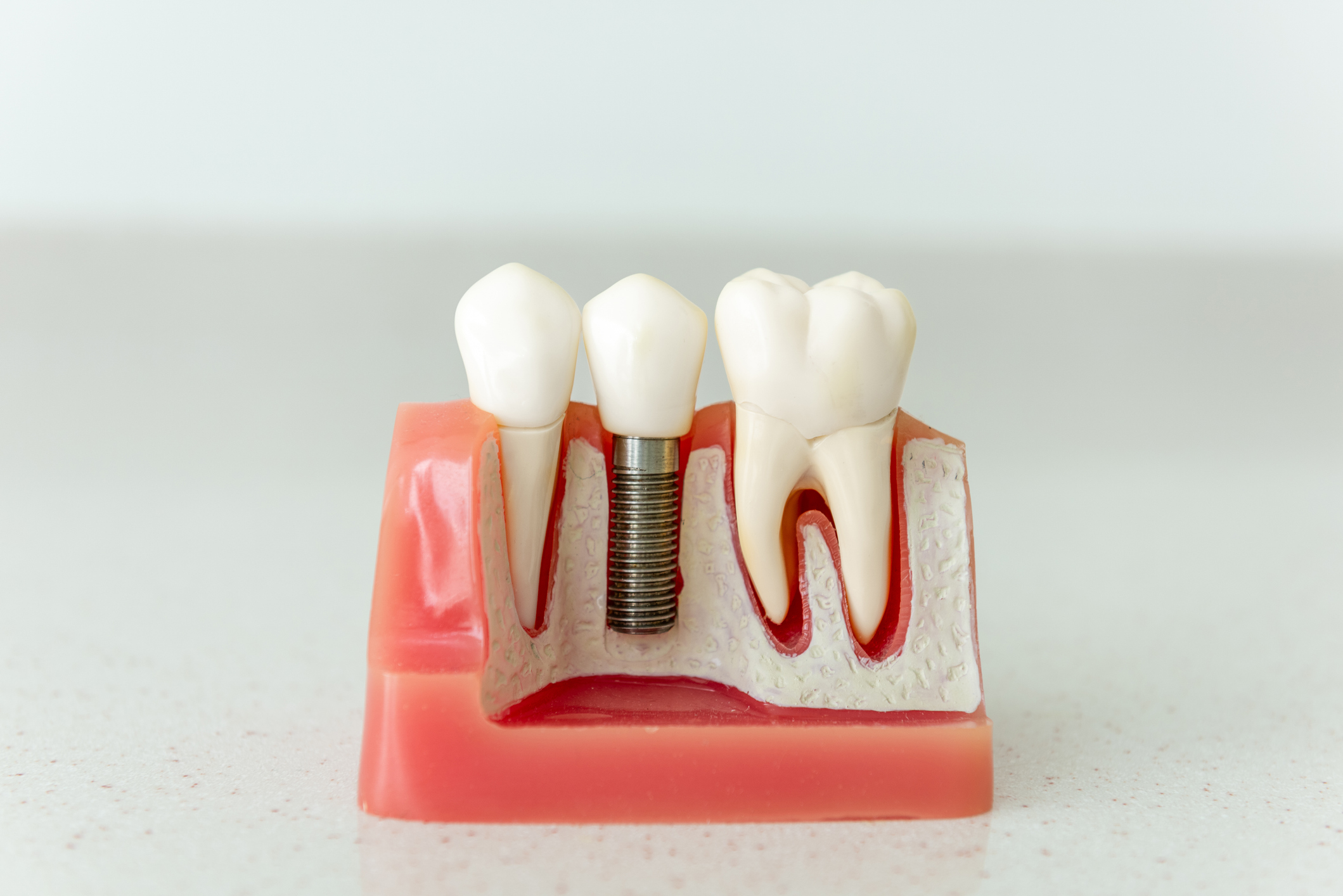 Dental implant model showing titanium implant post, abutment, and crown positioned between natural teeth.