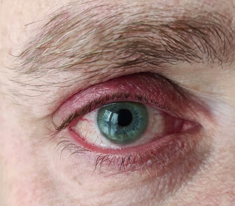 Blepharitis (Eyelid Inflammation): Causes & Treatment