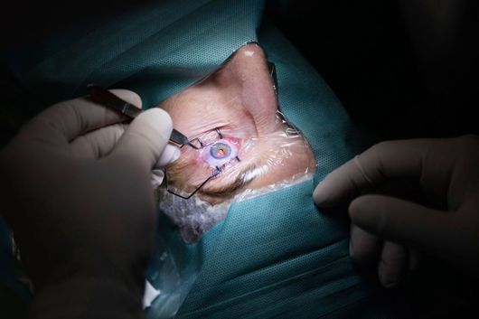 Man undergoing eye surgery