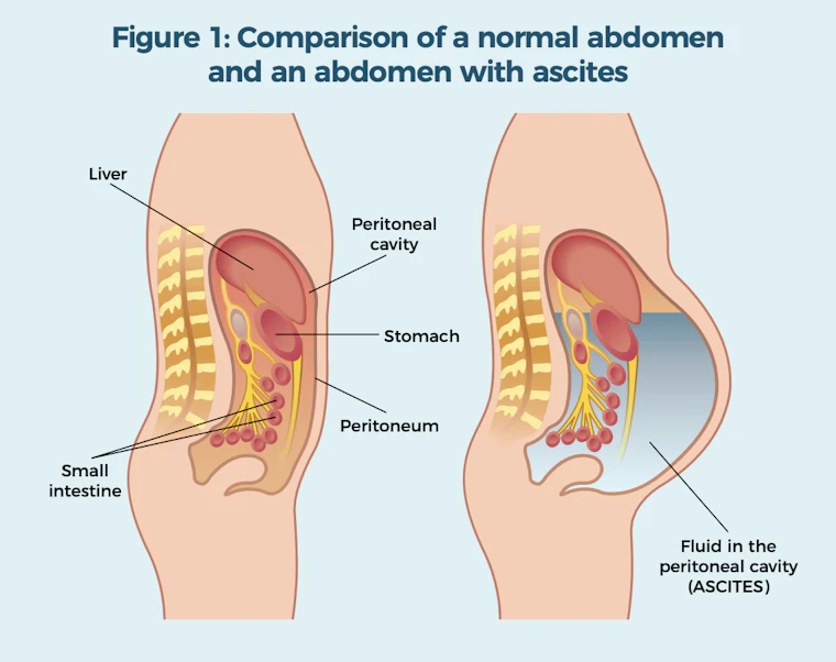 Ascites diagram