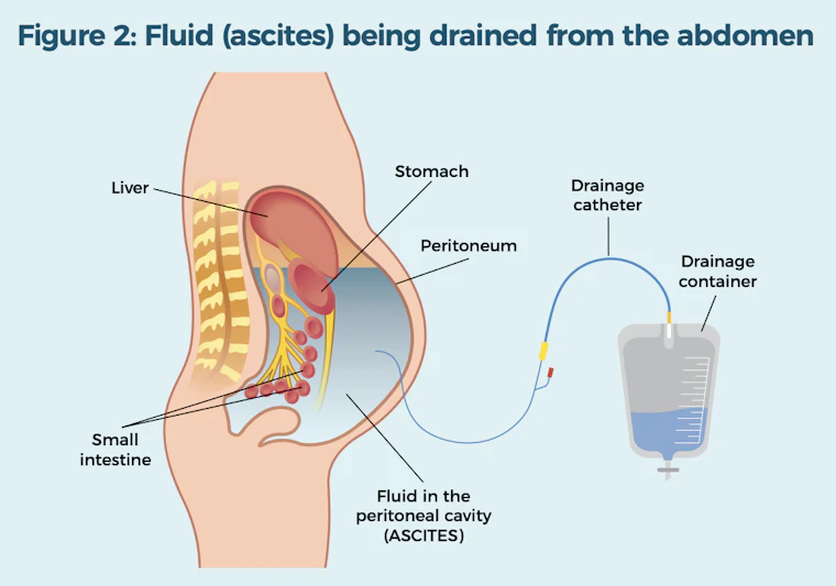 Fluid being drained from the abdomen
