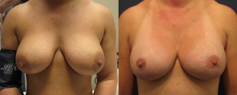 Breast Implant Revision Before & After Gallery - Patient 174146620 - Image 1