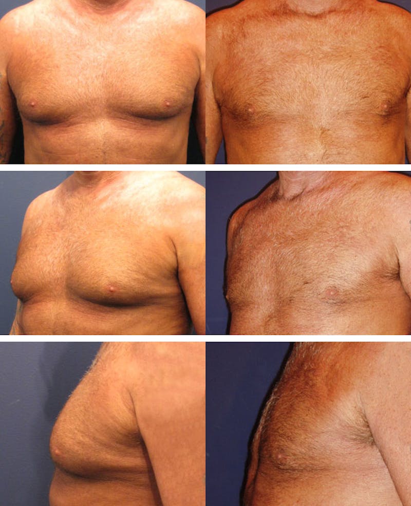 Male Breast Reduction/Gynecomastia Before & After Gallery - Patient 174150014 - Image 1