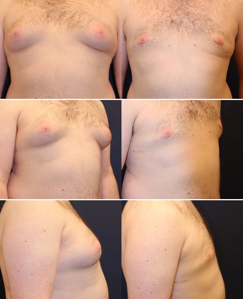 Male Breast Reduction/Gynecomastia Before & After Gallery - Patient 174150020 - Image 1