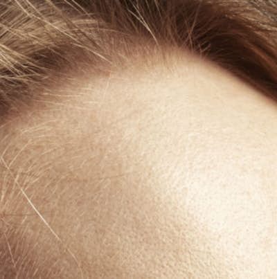 Closeup of a person's forehead.