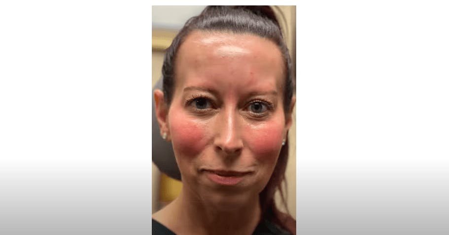 facial rejuvenation video thumbnail