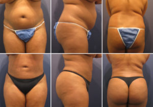 Before and after lipo