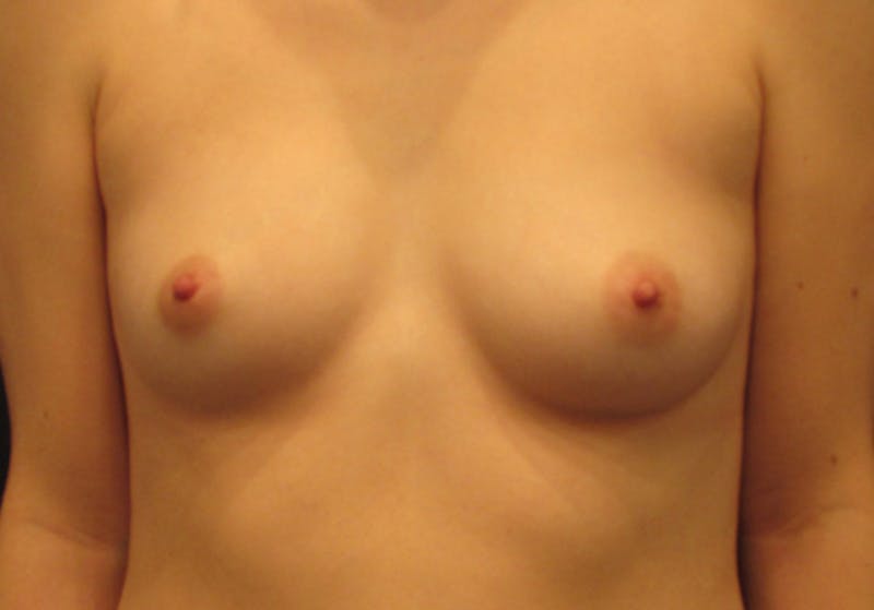 Breast Augmentation Before & After Gallery - Patient 178847212 - Image 1