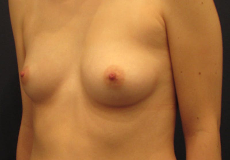 Breast Augmentation Before & After Gallery - Patient 178847212 - Image 3