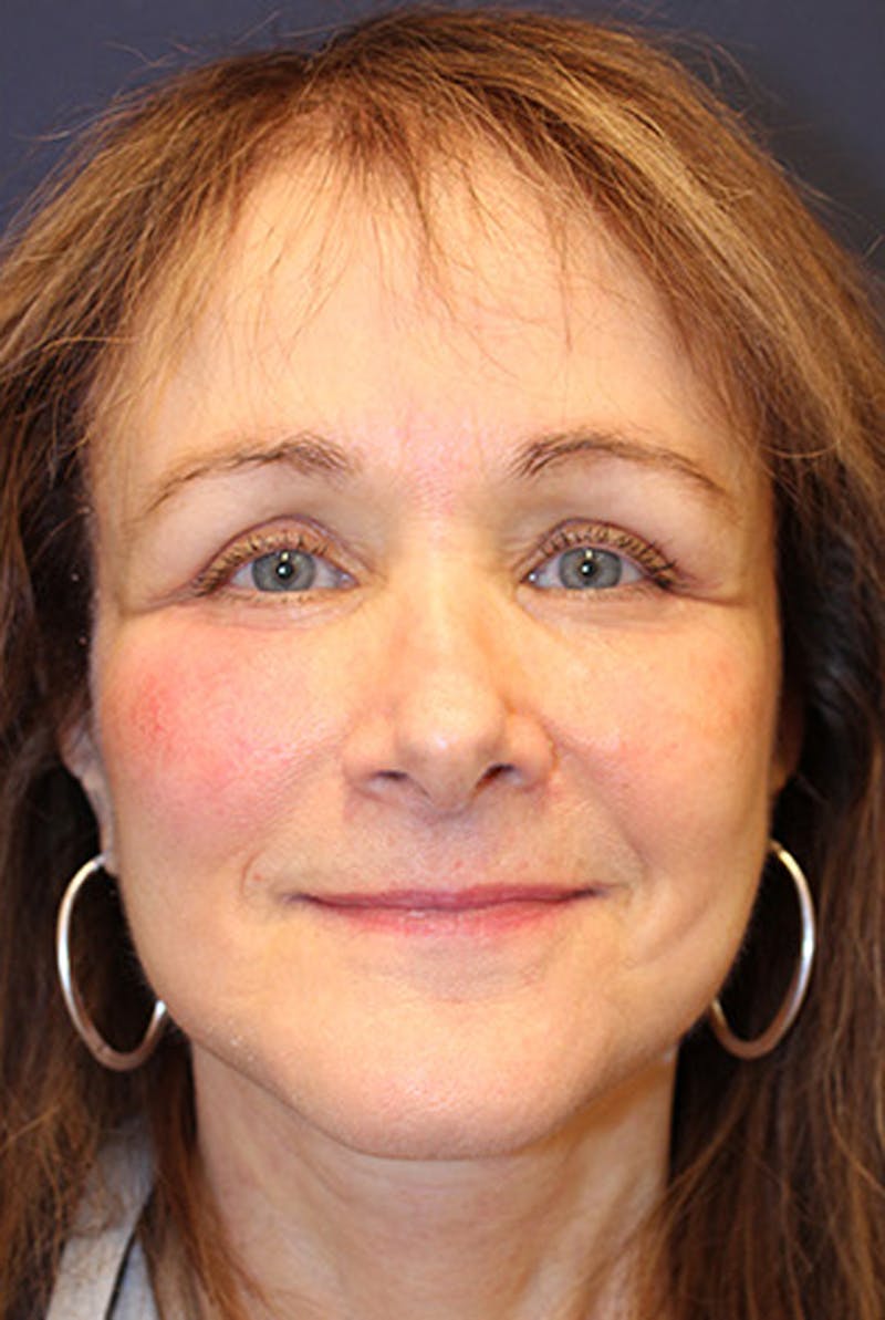 Brow Lift Before & After Gallery - Patient 174146382 - Image 2