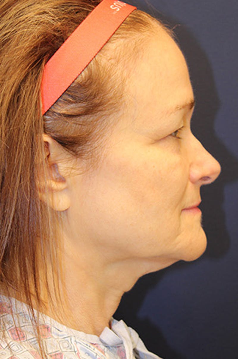 Brow Lift Before & After Gallery - Patient 174146382 - Image 5